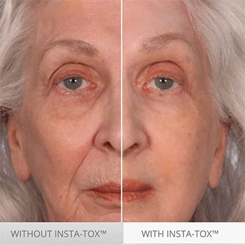 Insta Tox avant et après