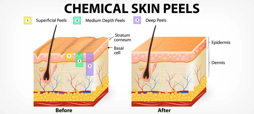 peeling quimico antes despues