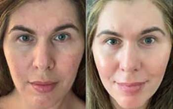Musely Before and After Natalie